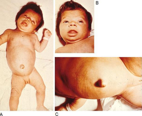 bệnh suy giáp bẩm sinh, suy giap bam sinh, sang loc so sinh, newborn screening,  rối loạn chuyển hóa do di truyền, roi loan chuyen hoa, di tat bam sinh